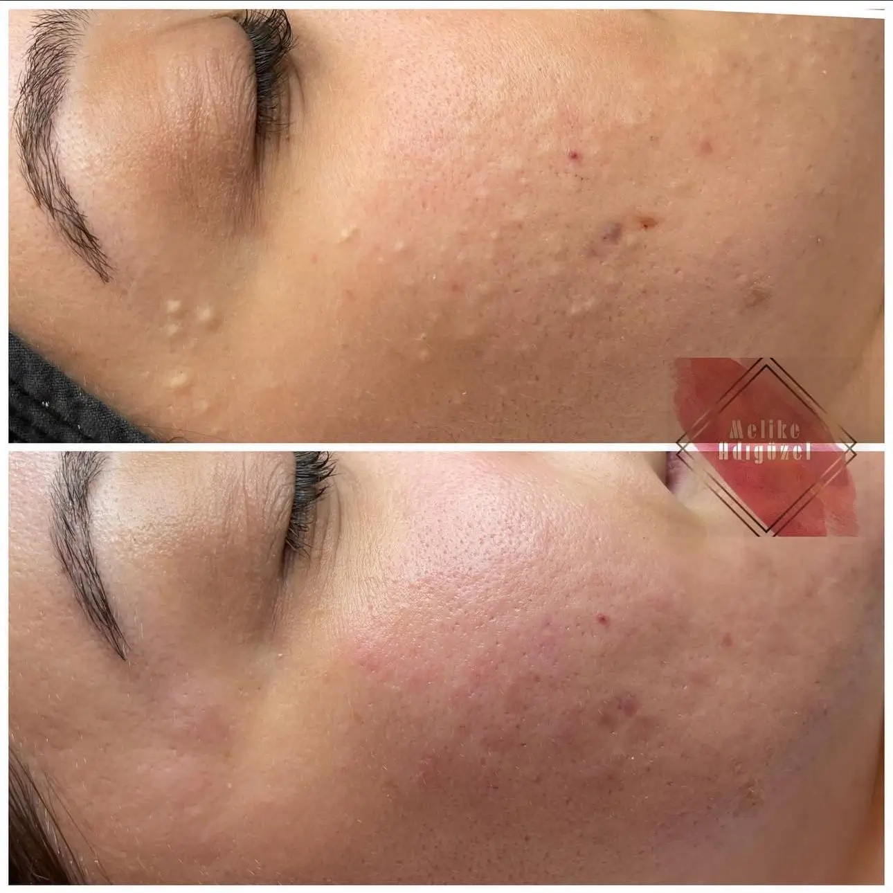 cilt bakımı öncesi sonrası
