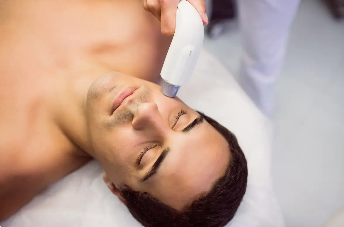 Sakal Bölgesi Lazer Epilasyon